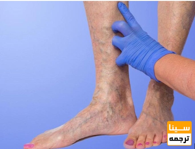 لیست مجلات ISI بیماری های عروق محیطی