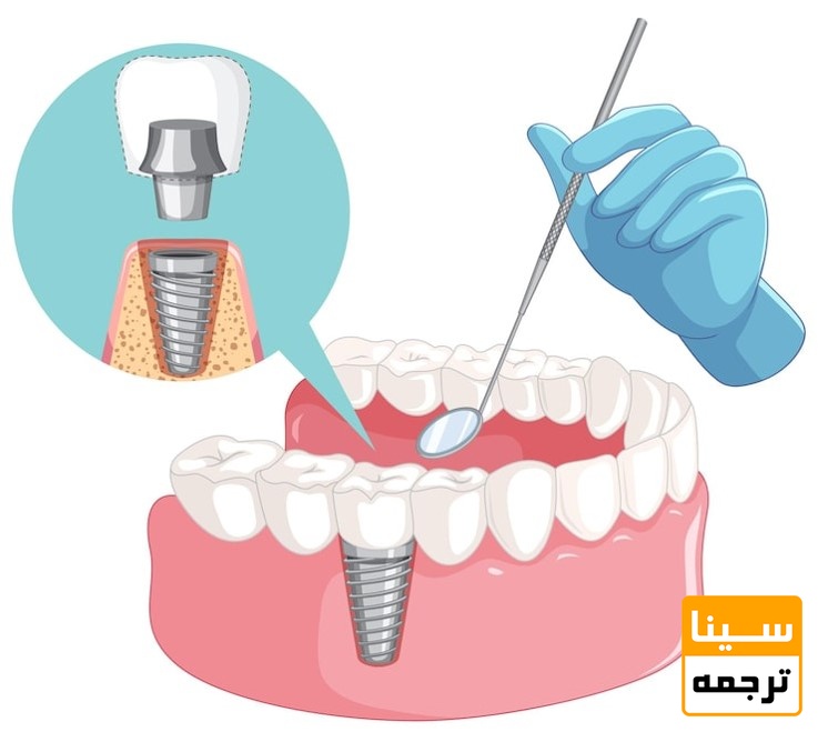 ایمپلنت‌های پزشکی