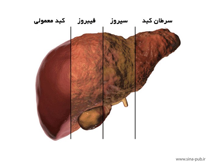 بیماری کبد چرب- علایم و نشانه های تشخیص